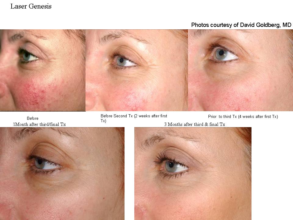 Laser Genesis Treatment for Wrinkles Crows Feet and Redness and Rosacea at DermaSpa Ajax Pickering