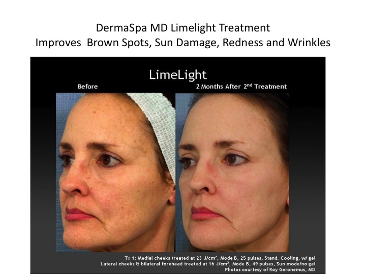 Limelight and Laser Treatment for Brown Spots and Pigmentation at DermaSpa Ajax Pickering