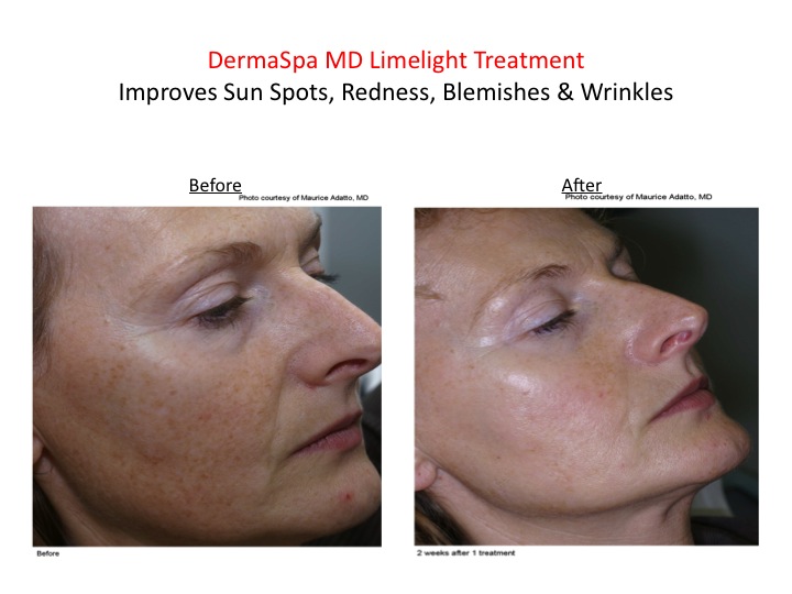 Laser Skin Rejuvenation for Redness, Sun Damage, Sun Spots and Wrinkles at DermaSpa Ajax Pickering and Whitby