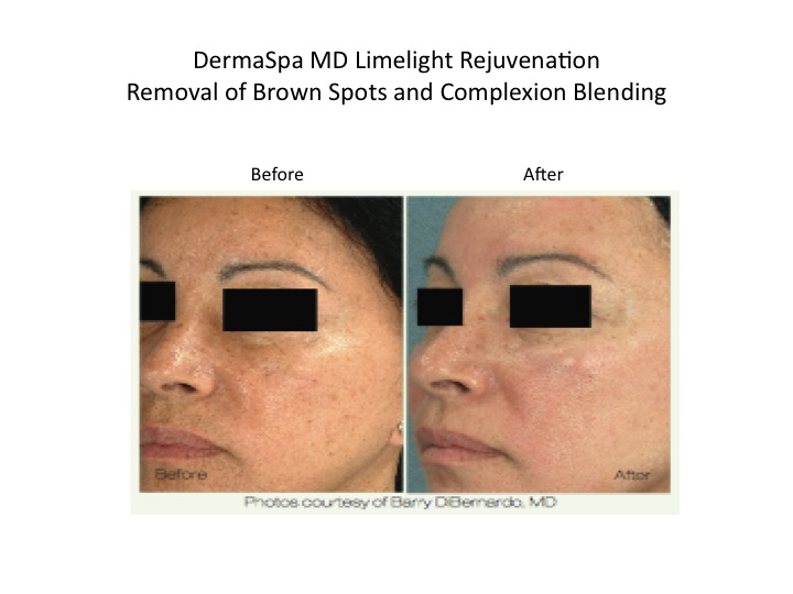 Pigmentation and Brown Spots treatment at DermaSpa for Ajax, Pickering and Whitby