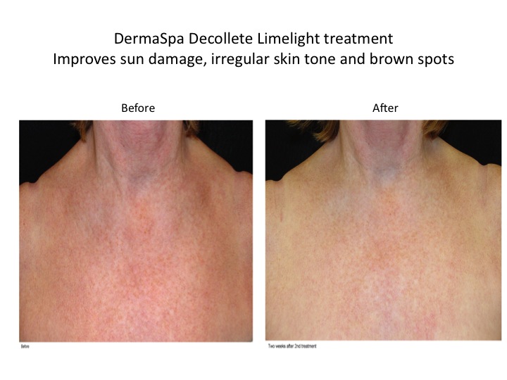 Chest and Decollete Treatment for Sun Damage and Anti-Aging and Redness at DermaSpa Pickering Ajax and Whitby