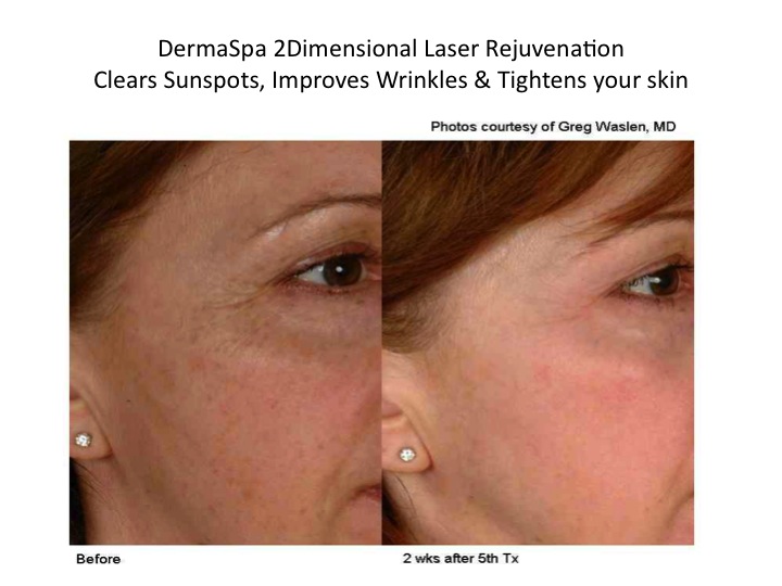 Laser Rejuvenation for Sun Spots, Pigmentation, Anti-aging, Wrinkles, Crows Feet at DermaSpa Ajax Pickering