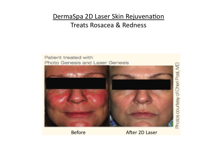 Laser Treatment of Rosacea DermaSpa Ajax Pickering