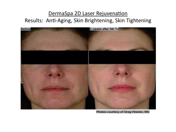 Skin Whitening, Lightening and Brightening Treatment and Skin Tightening and DermaSpa Ajax Pickering
